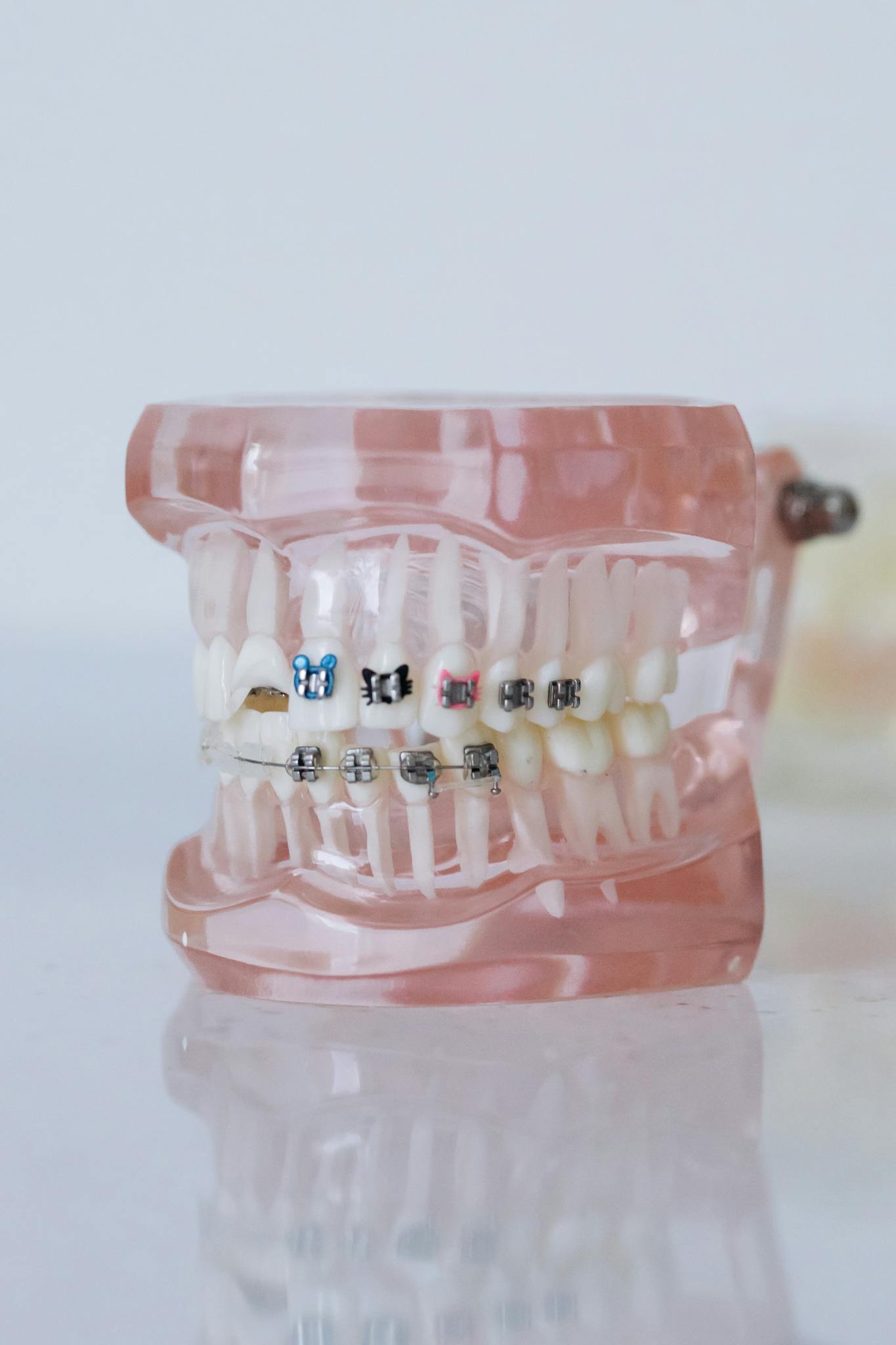 close up shot of dentures with braces Best Orthodontist in Colorado | Braces, TMJ Treatment, Clear Aligners