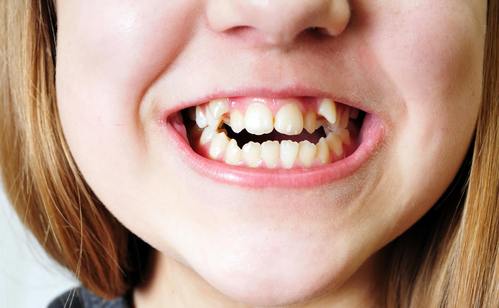 d4c10461 9e0b 4651 aa5a bd8708f2e28b Why Do Kids Need Braces? When Early Orthodontic Treatment is Necessary