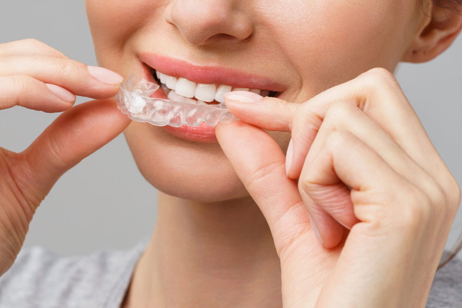 What’s An Overbite? Signs, Causes, & Treatments - Orthodonticscolorado.com