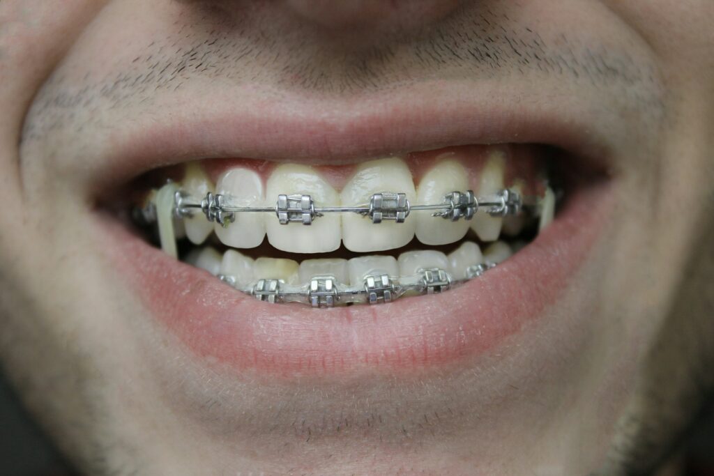 Finding Affordable Braces Near You