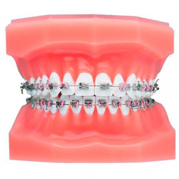 Braces for Kids - Types, Cost, & When to Start 2 Mini Braces for Kids
