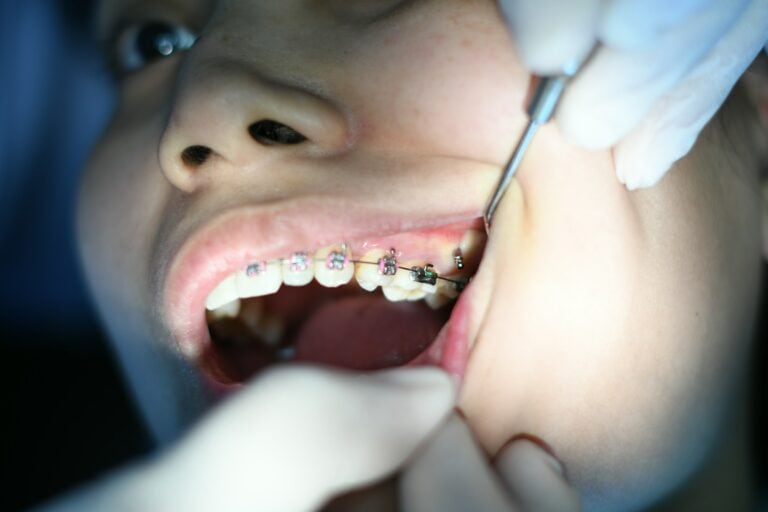 How Long Can You Go With a Loose Bracket Before getting it fixed by your orthodontist?
