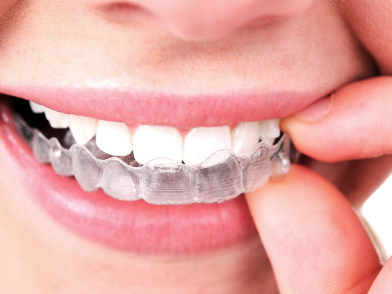 What to Know about Invisalign Touch Ups in Longmont Colorado