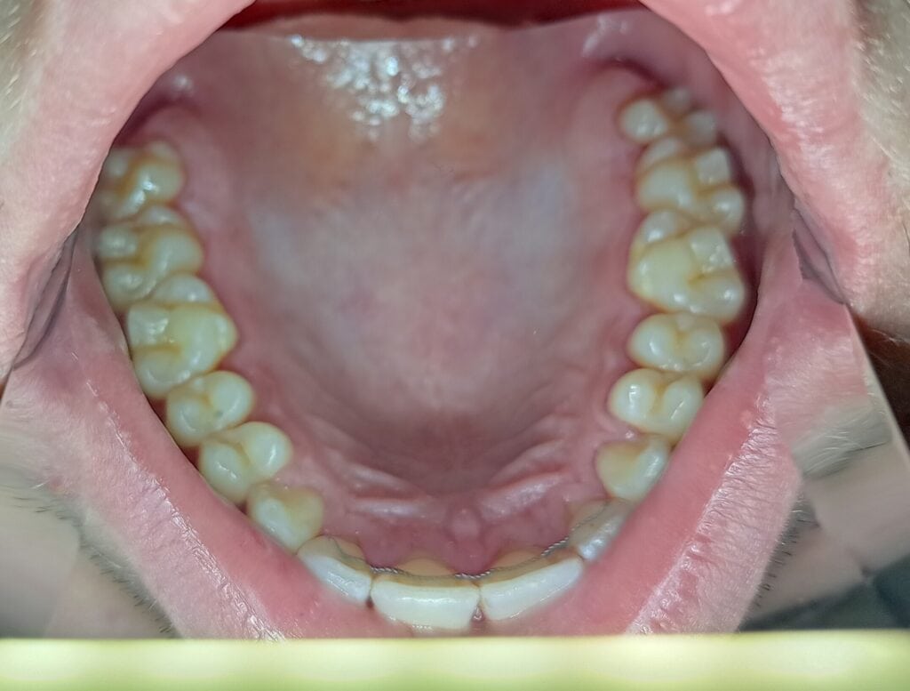 Permanent Retainer After Braces-Permanent Retainer Cost-Orthodontics Colorado