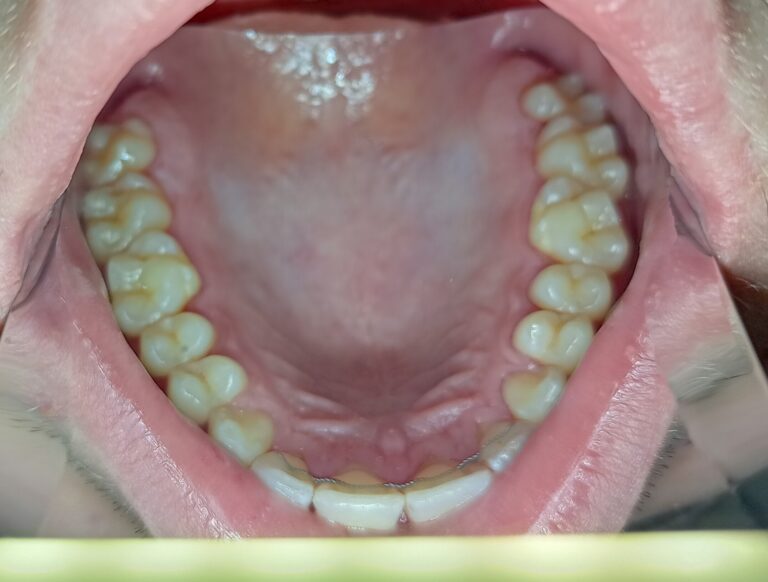 Permanent Retainer After Braces-Permanent Retainer Cost-Orthodontics Colorado