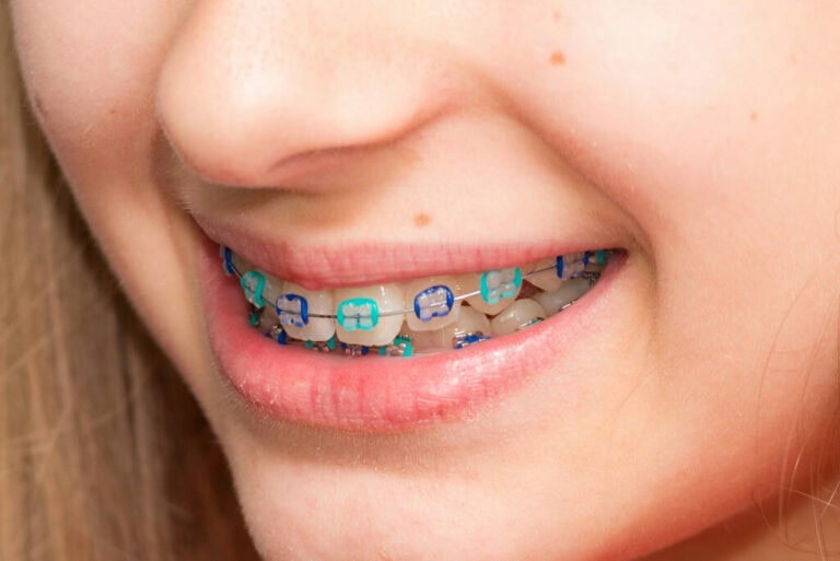 What are the best braces colors? Orthodontics Colorado Braces Color Wheel Braces Color Palette