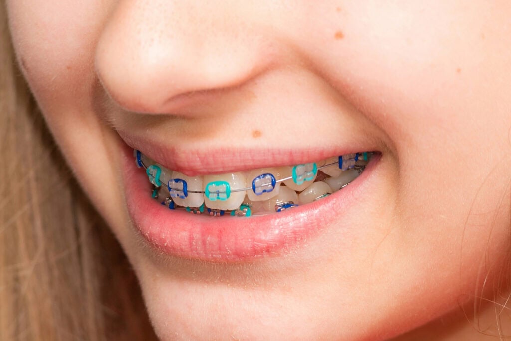 What are the best braces colors? Orthodontics Colorado Braces Color Wheel Braces Color Palette